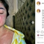 Dewi Perssik tunjukan badan penuh bercak merah (Instagram.com/dewiperssikreal)