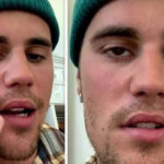 Justin Bieber Diserang Penyakit Langka Ramsay Hunt Syndrome, Kelumpuhan pada Wajah