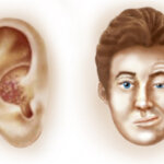 ilustrasi penyakit Ramsay Hunt Syndrome