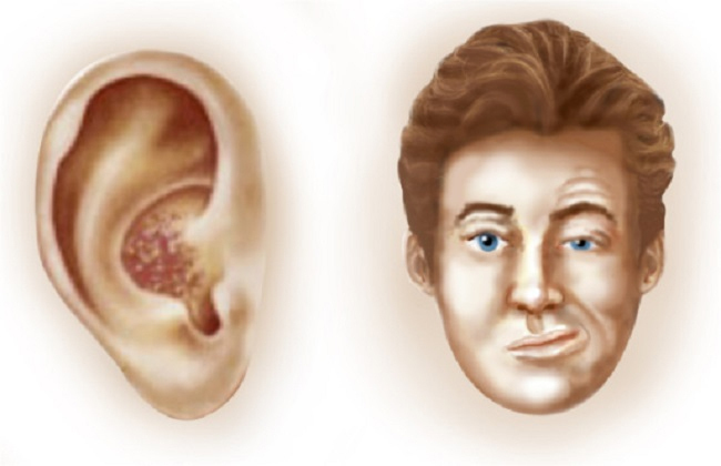 ilustrasi penyakit Ramsay Hunt Syndrome